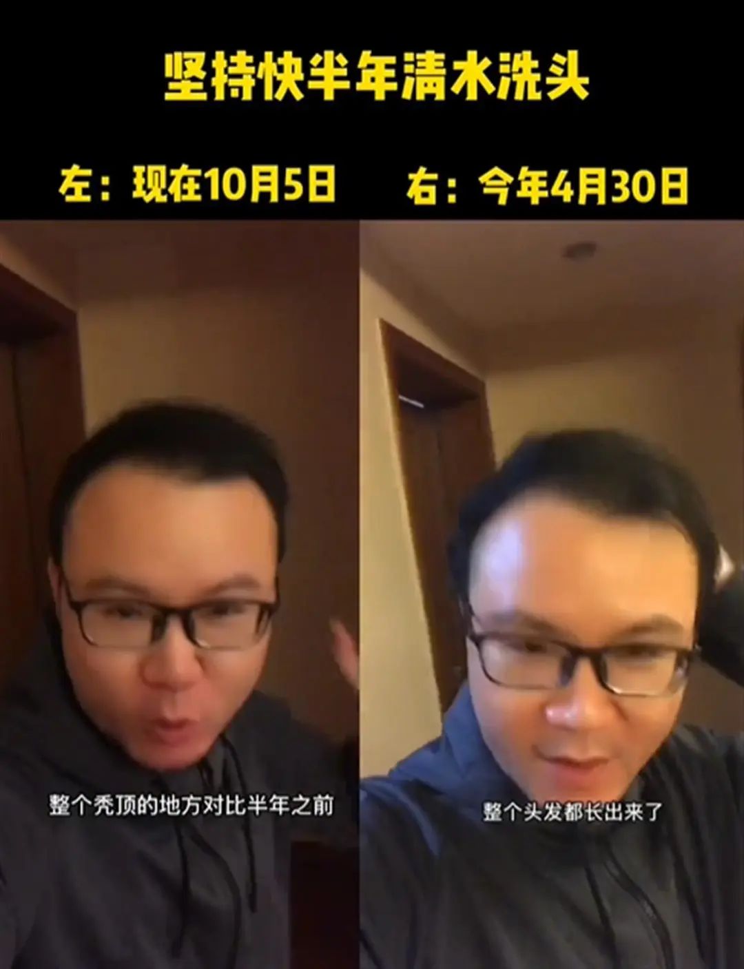 男子不用洗发水从秃顶变满头黑发？当事人回应