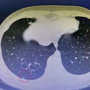 11岁男孩查出肺结节，一年后竟变肺癌！只因忽略这件事……