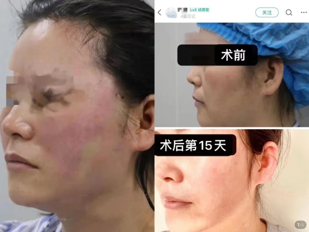 免费体验6万元医美项目后感染，新氧、元美回应