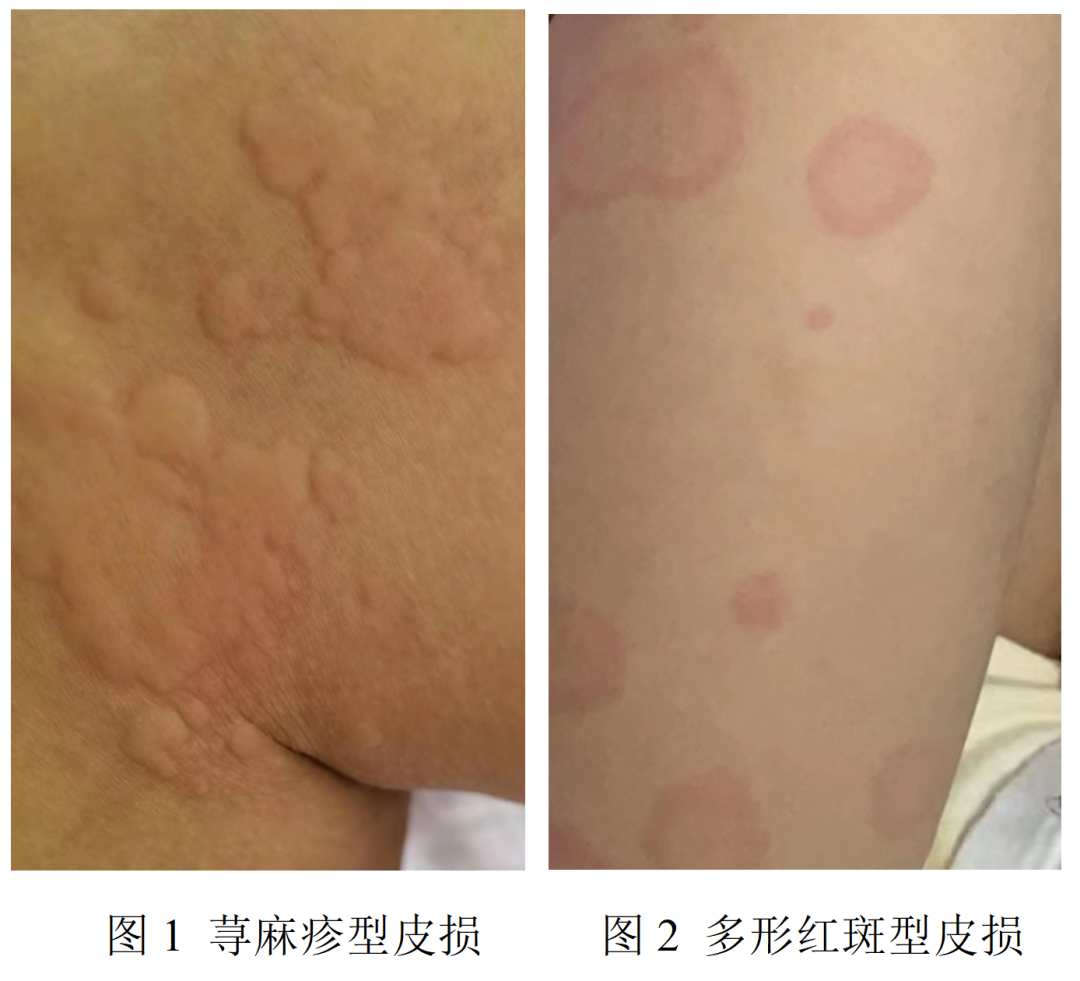 新冠病毒感染，可能会带来哪些皮肤损害？