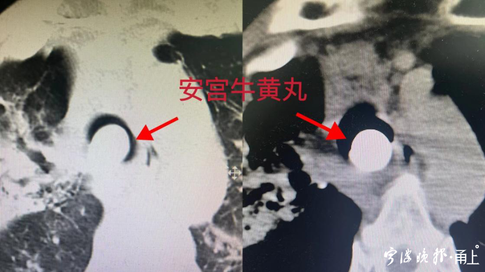男子感染后氧饱和度掉到80%，竟因吃了这个“神药”