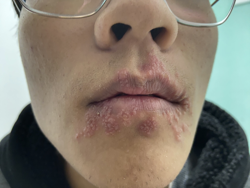 疼痛剧烈！不少人“阳”后患上这种病