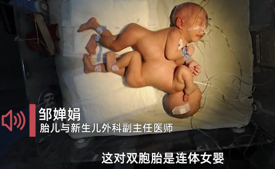 真好！术后14年，连体女婴长成健康姐妹花