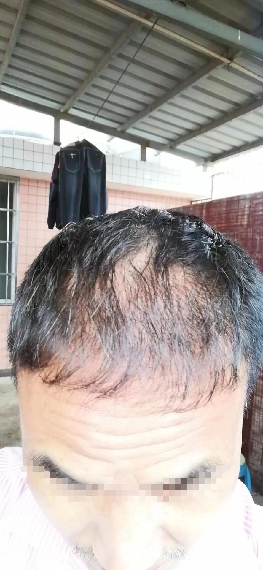 长沙男子植发一年后头发稀疏方向还长得不一致？回应：他对植发技术有误解 ...