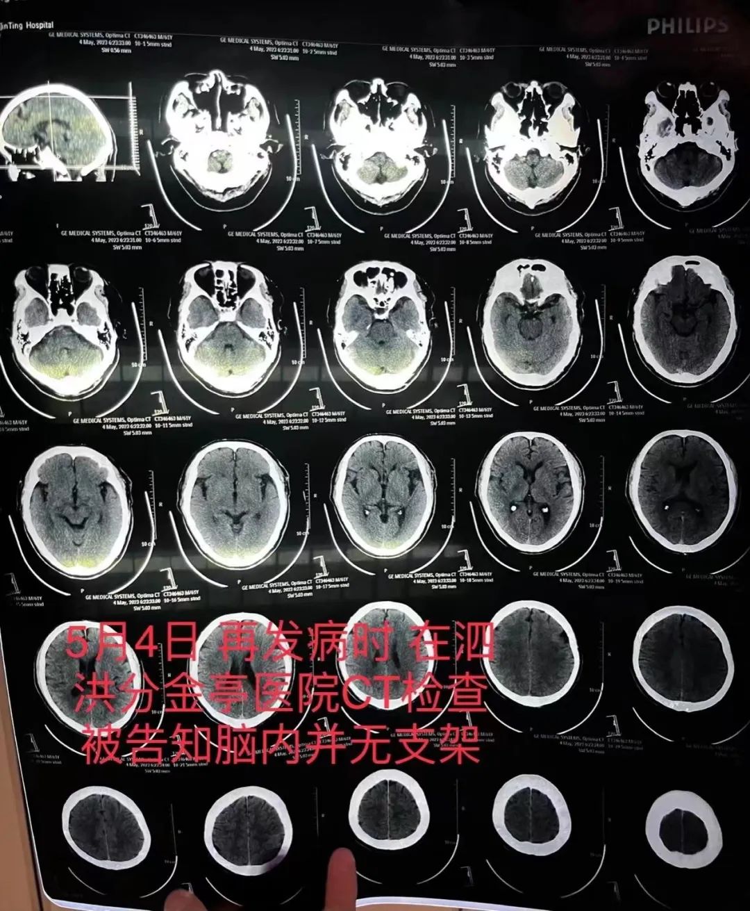 手术后发现植入的支架“不见了”！患者不幸去世，医生承认隐瞒真相：很打脸…… ... ...