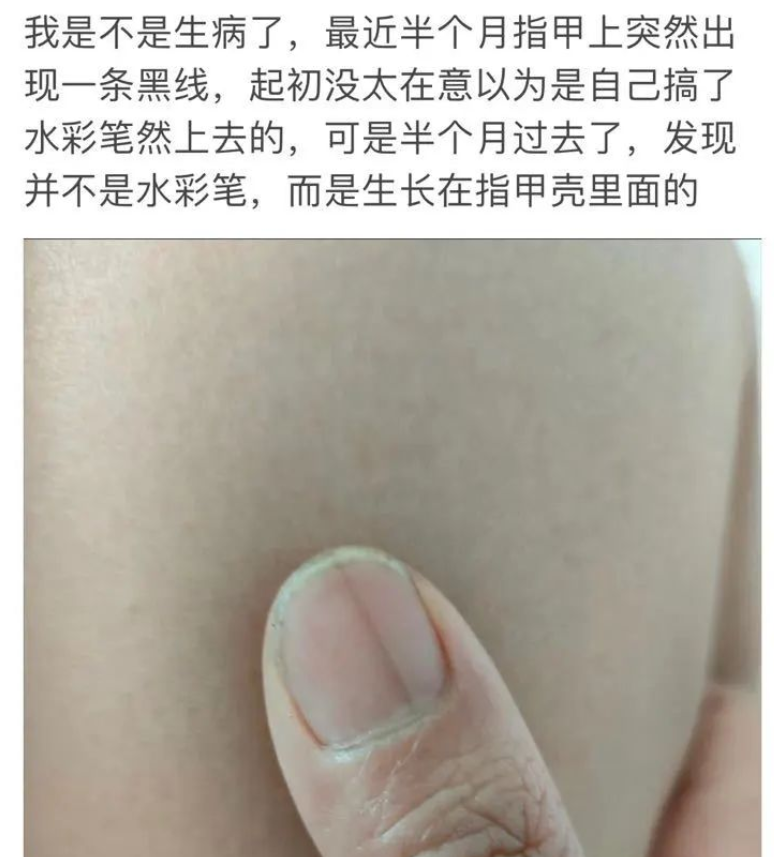 冲上热搜！指甲上突然长了一条黑线，网友慌了……