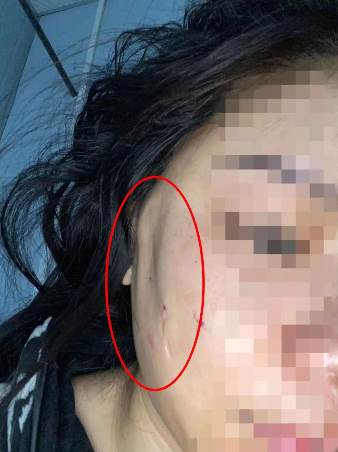 长沙女子称美容后“脸凹了”，门诊部：可以鉴定后起诉