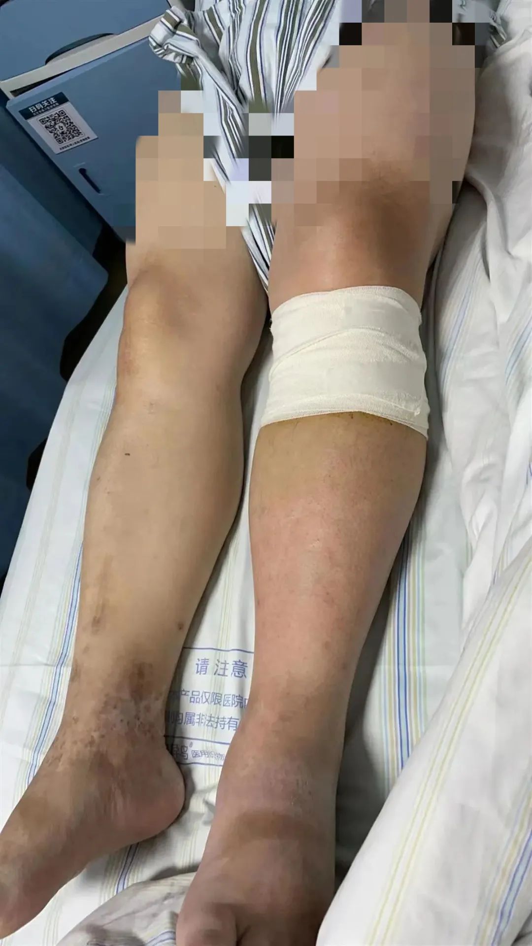 25岁小伙一觉醒来下肢肿成“大象腿”，无法行走，原因让人吃惊 ... ...