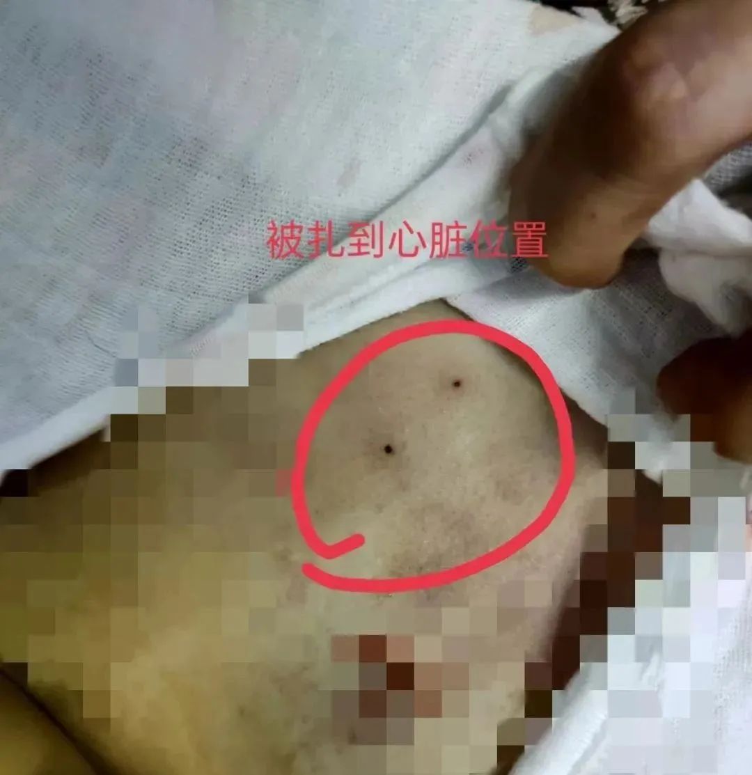 4岁女童穿刺时被扎破心脏，命丧手术台！院方回应→