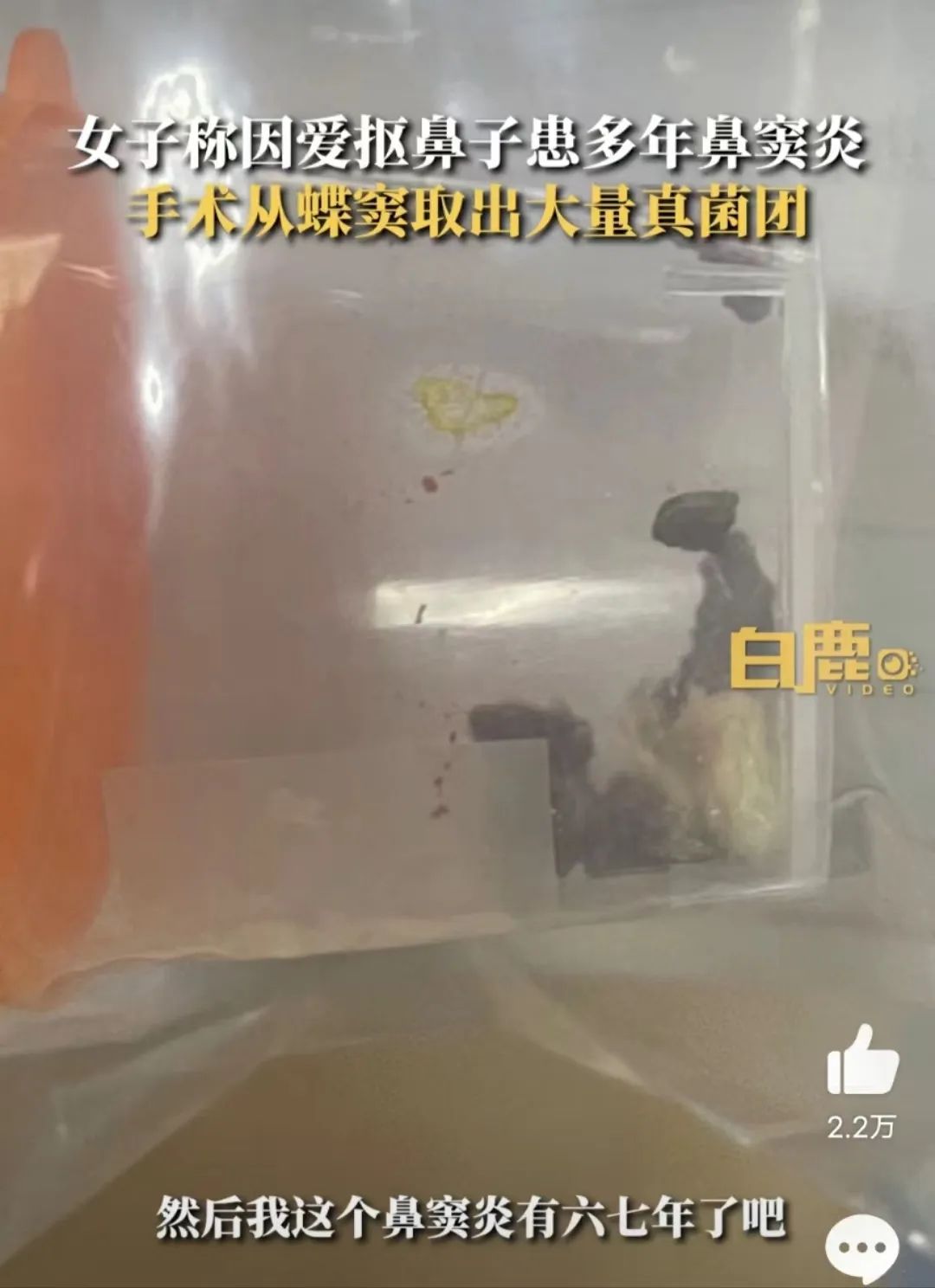 又上热搜！这次是挖鼻孔惹的祸，医生紧急提醒→
