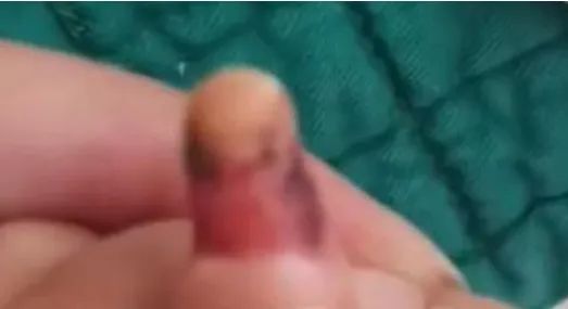 小心！10个月宝宝被拔倒刺送PICU抢救