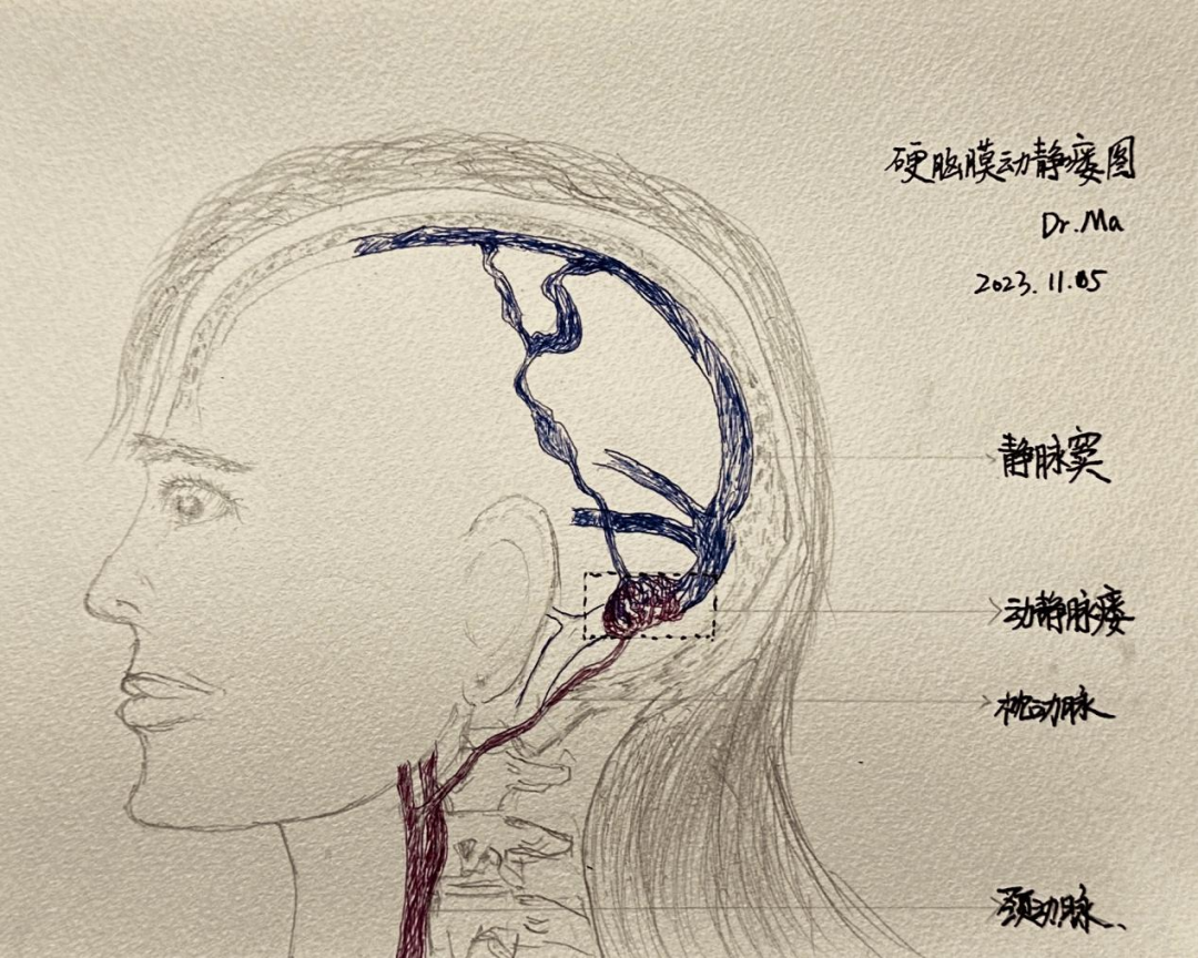 脑子里有“风声”？医生提醒：小心是这病