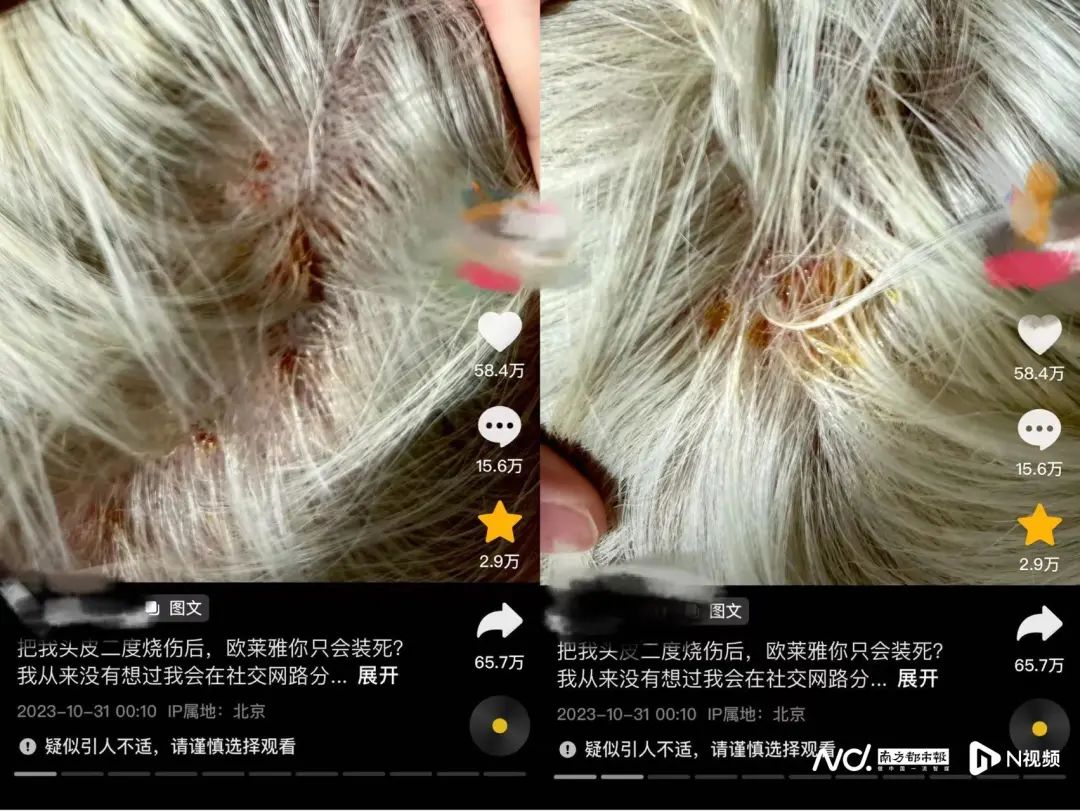 花5000块去旗舰店染发，竟致二度烧伤！“发型师神奇消失”