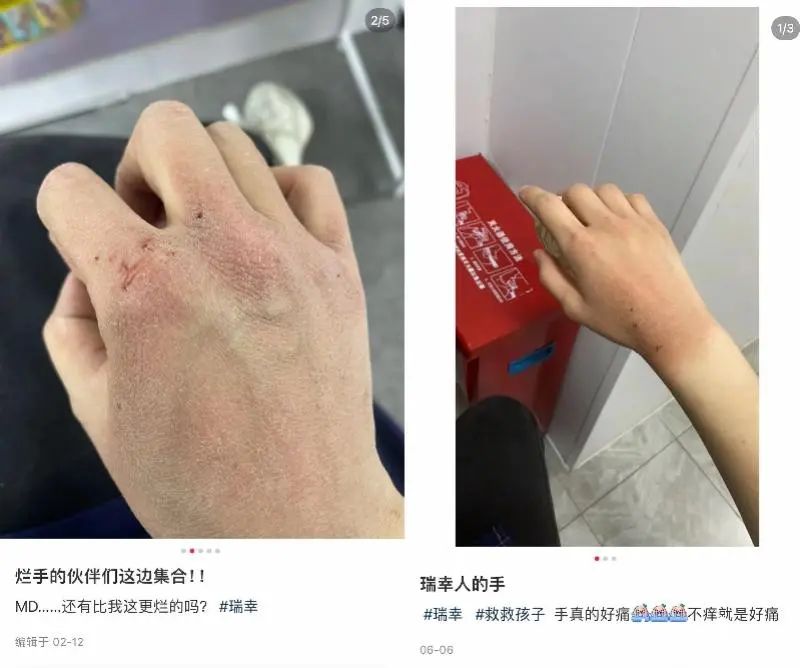 “烂手”冲上热搜第一！很多员工都在晒：这算工伤吗