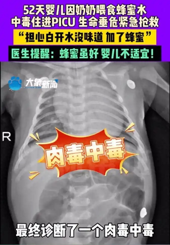 52天宝宝中毒进ICU，竟因奶奶往水里加了点蜂蜜！医生提醒