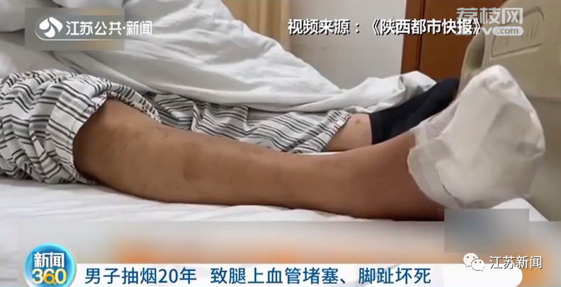 “不敢再吸烟了！”37岁小伙五个脚趾全部坏死，面临截肢…