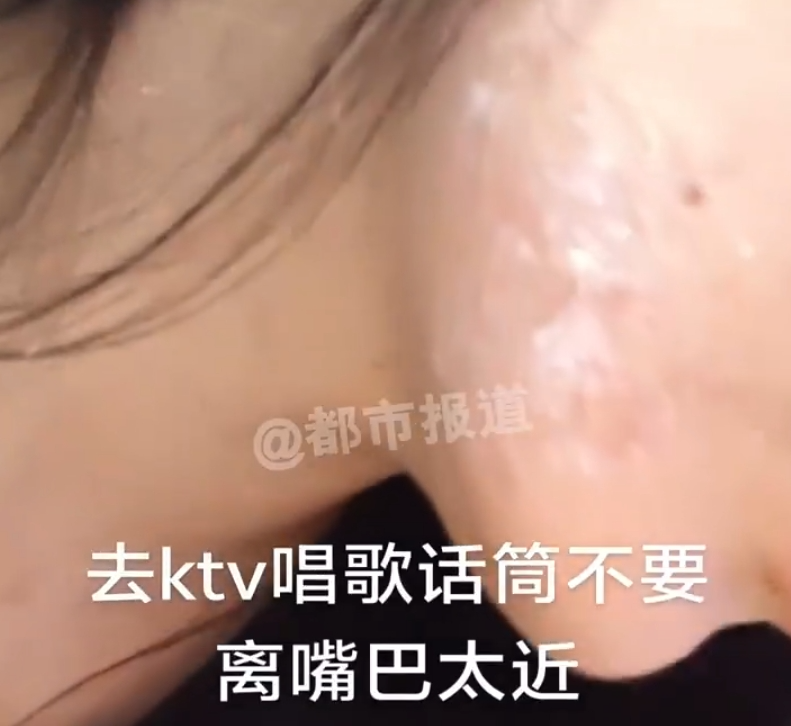 女子称唱K离话筒太近感染病毒，无药可治！“此病毒终身携带……” ... ...