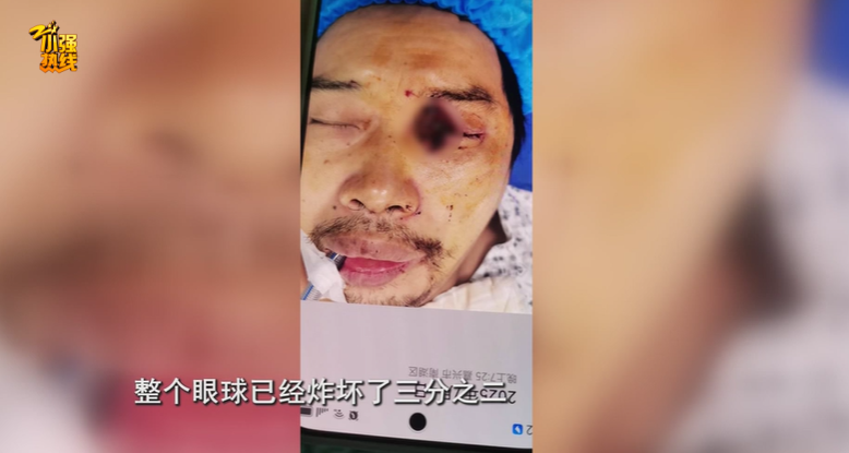 突然炸了！浙江一男子眼球被炸破，元凶是它？夏天不少人会接触 ... ...
