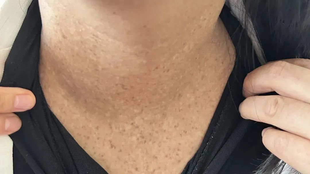 越来越黑！杭州女子脖子总洗不干净，竟是中了“砒霜”之毒！医生：她有个习惯…… ... ...