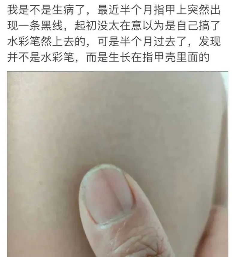 别不当回事！指甲出现这个变化，可能是癌变