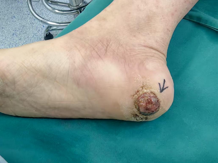 女子脚被扎伤后, 竟长出“癌中之王”! 真相令人揪心, 医生紧急提醒↗ ... ...