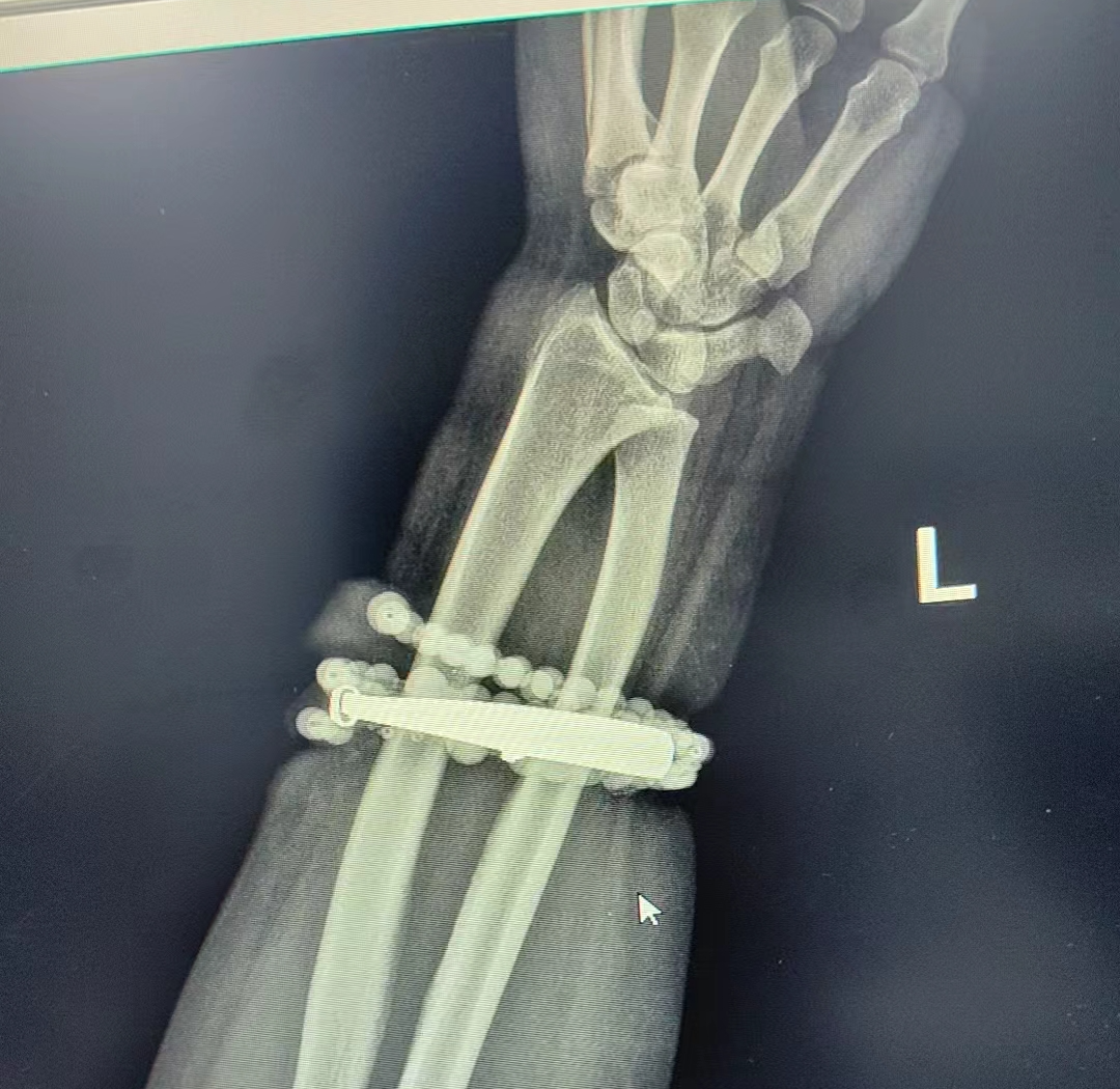 女子手镯10年没摘竟“长”进肉里！医生：再晚点就保不住了！ ... ...