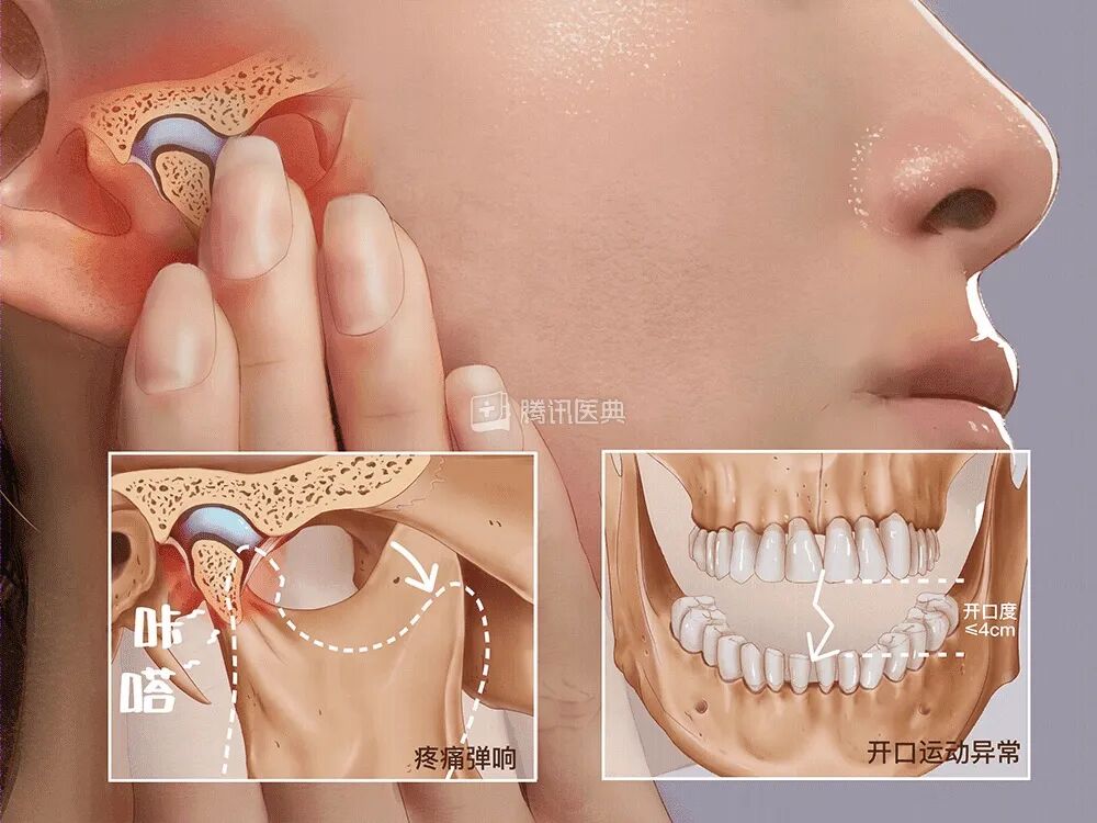 一觉醒来，25岁女子张不开嘴！很多深圳人遭遇，这四种现象要当心 ... ...