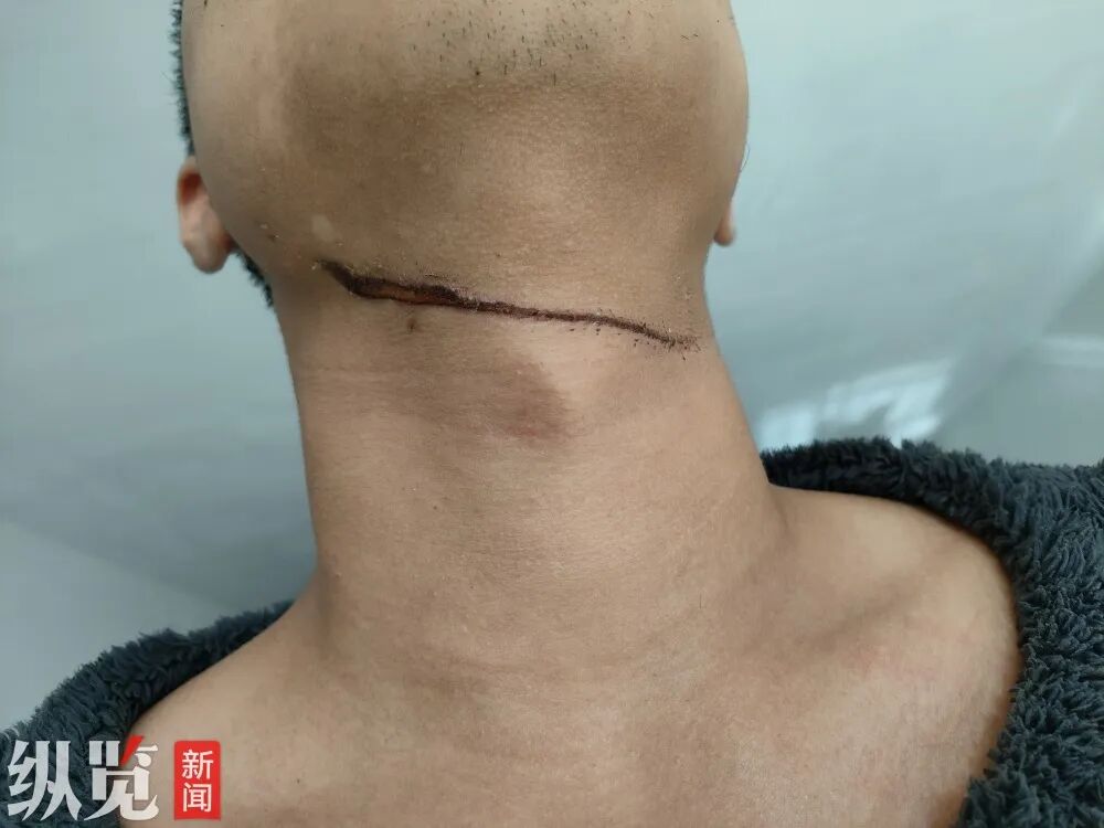 “一摸满手是血”！男子夜骑遭晾衣绳“割喉”，勒痕长达10厘米左右，物业：事发监控盲 ...