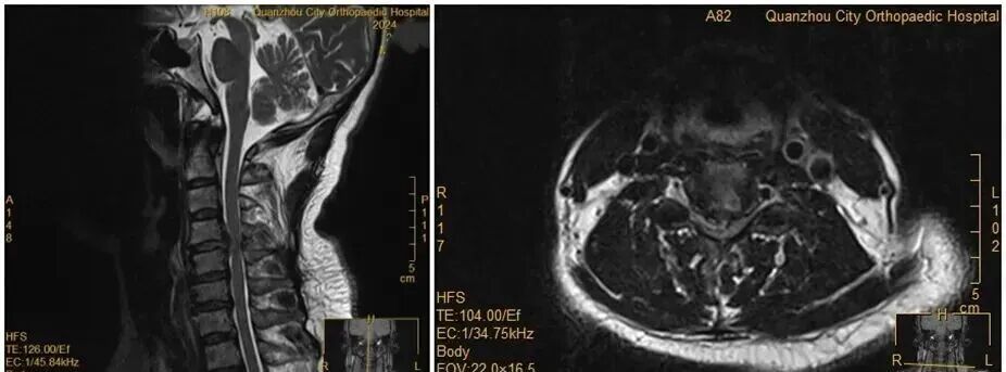 女子夜里翻身拿手机，突然瘫痪！医生提醒：出现这些症状千万小心 ... ...