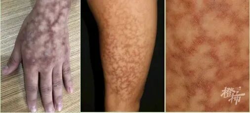 一觉睡醒长出“蟒蛇纹”、水泡！冬季警惕这类烫伤→