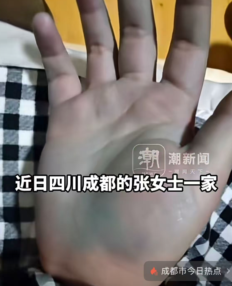 女子在家自制牛瘪火锅，4人食用后集体中毒，双手发蓝、上吐下泻，当事人：汤底加入一  ...