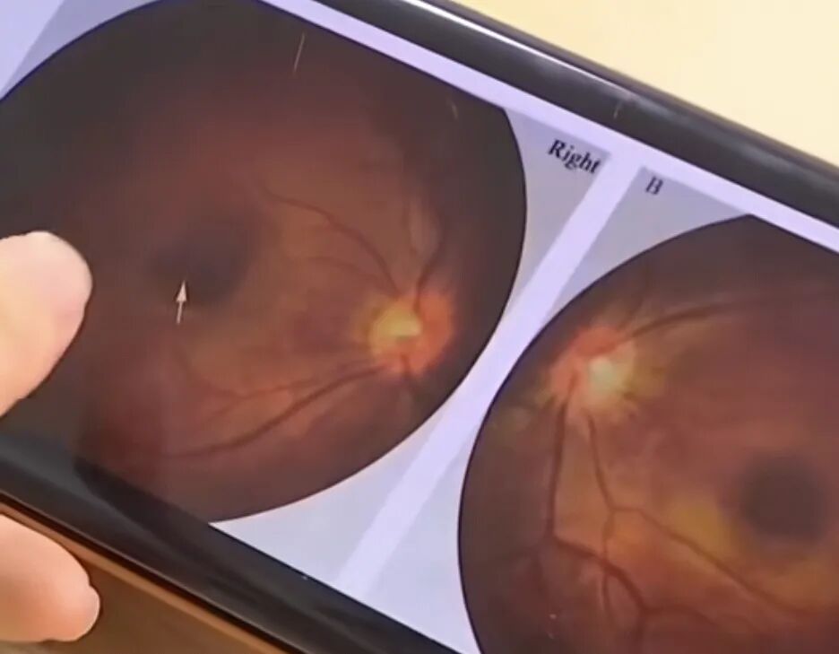 福建6个月大婴儿连续多日洗澡直视浴霸灯光，致终身弱视 ，医生提醒！ ...