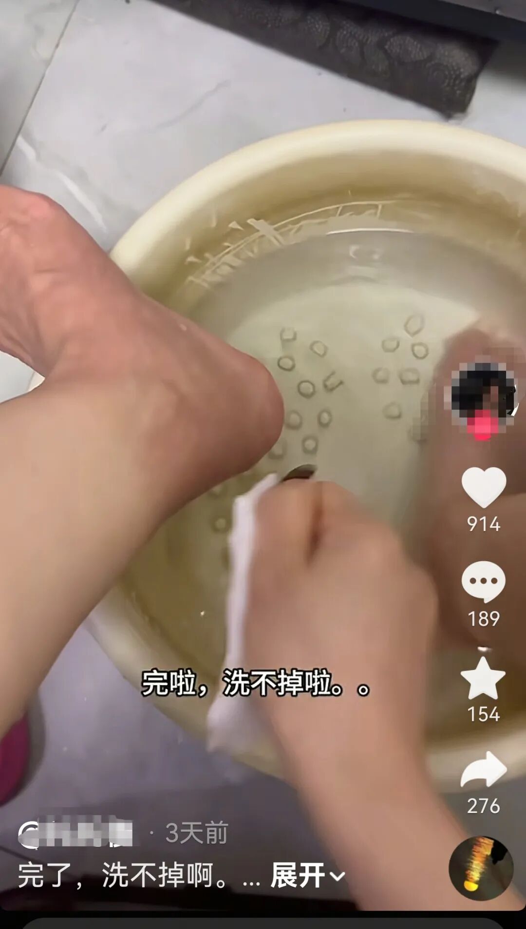 江苏一女子用中药包泡脚3个月，以为脚被染色狂搓仍洗不干净，医生：足部毛细血管反复  ...