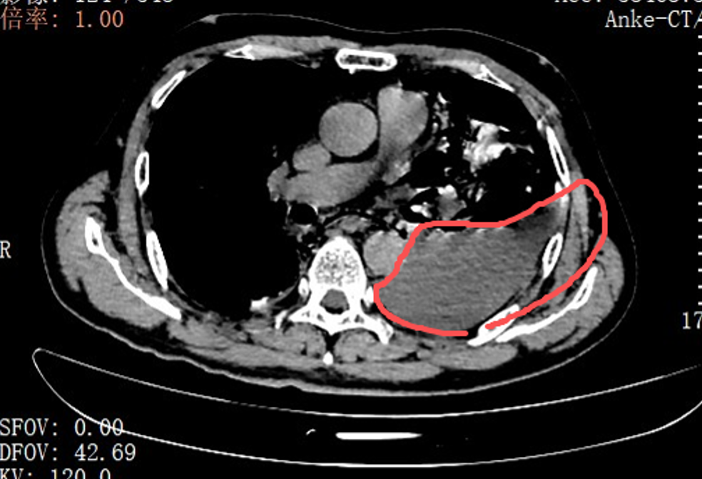 “胸口像被炸开”！吃了2个叉烧包，深圳男子凌晨紧急送医！医生：胸腔里全是剩菜渣 ...