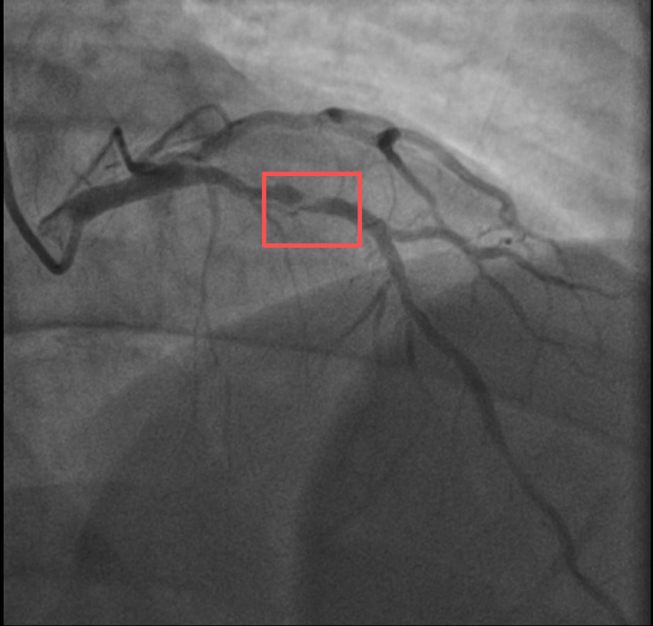 同一天，两位38岁宝爸突发心梗！其中一人仅打了10分钟羽毛球……医生提醒→ ... ...