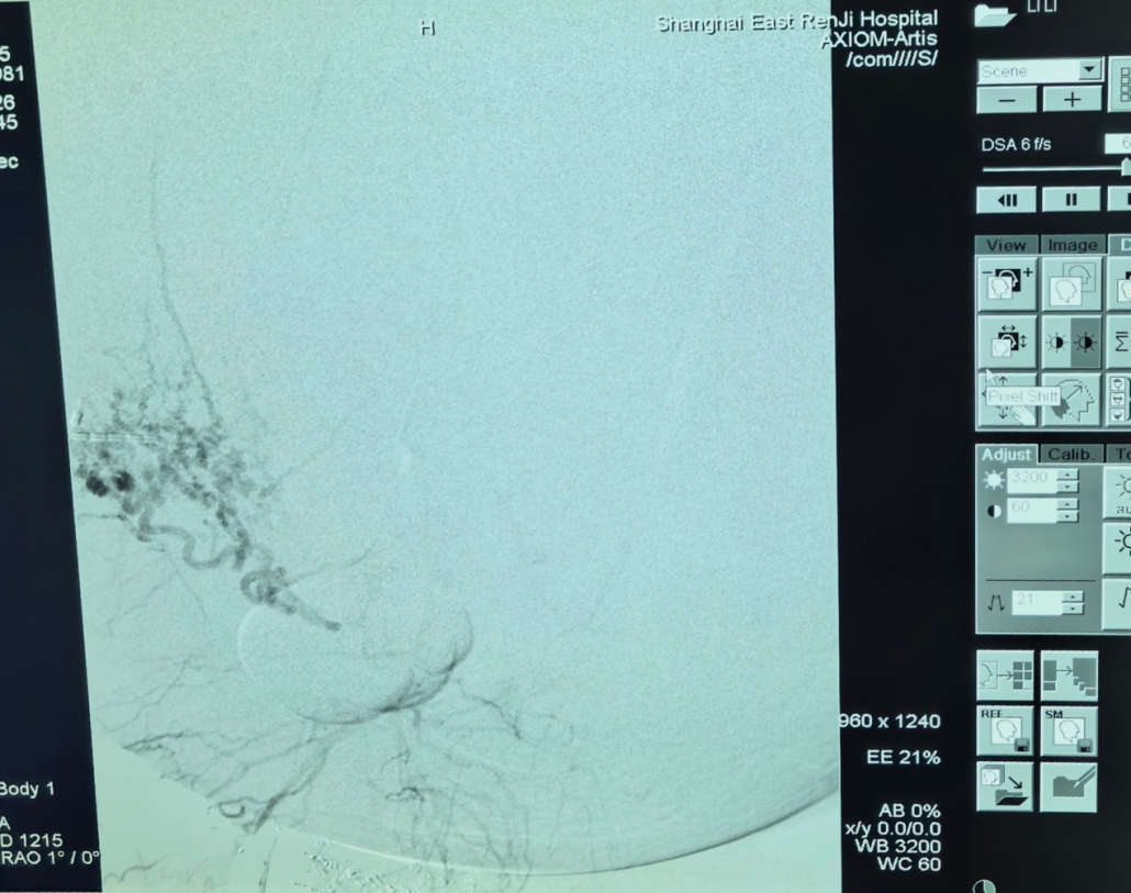 45岁女子肚子疯狂膨胀，比怀孕还夸张！以为是中年发福，结果取出56斤重的“超级巨瘤” ...