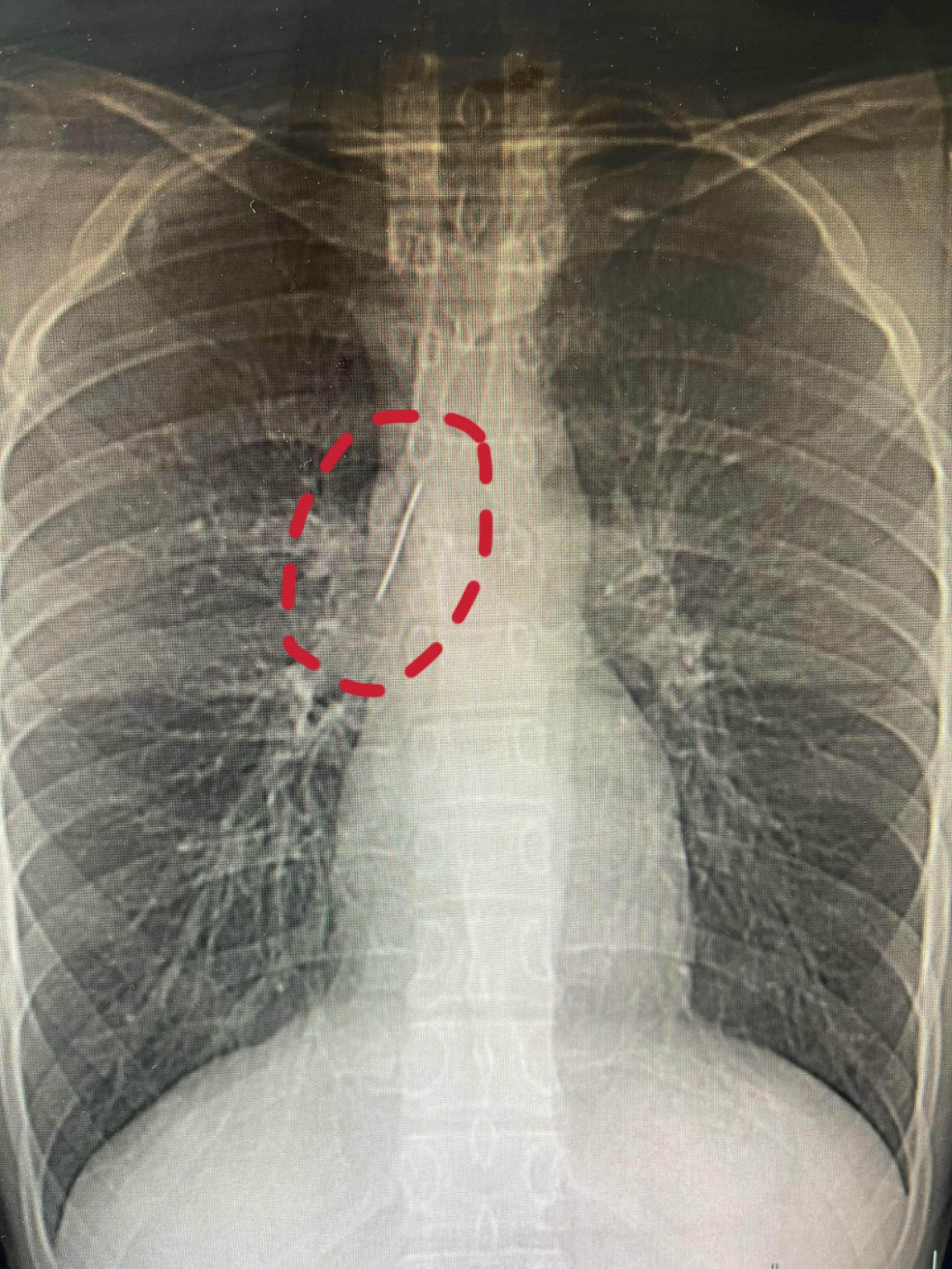 浙江一17岁小伙体检时发现胸腔藏了一根5厘米的缝衣针，医生：奇迹！紧贴大血管、刺入  ...