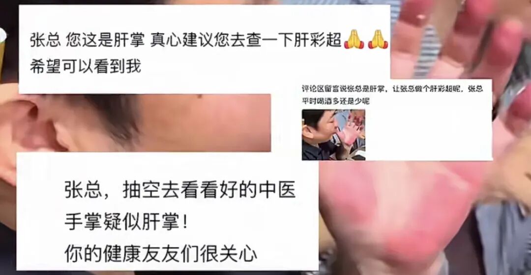 手掌红到显眼，网友心疼催就医：别再“肝”啦！张雪：我也不知道啥问题…医生提醒：这 ...