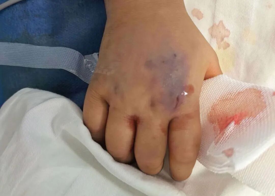 3岁女童被毒蛇咬伤，“假死”3天后奇迹生还！