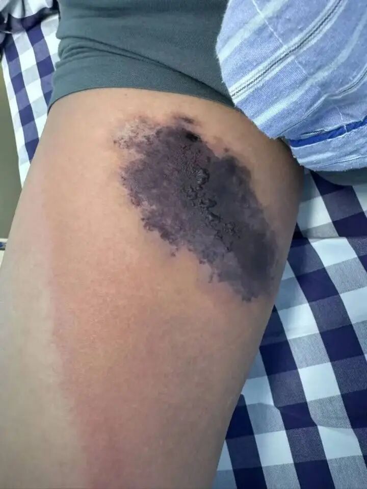 太毒了，还有可能致命！浙江杭州男子换季整理衣柜被“偷袭”，引发全身红斑、水疱 ... ...