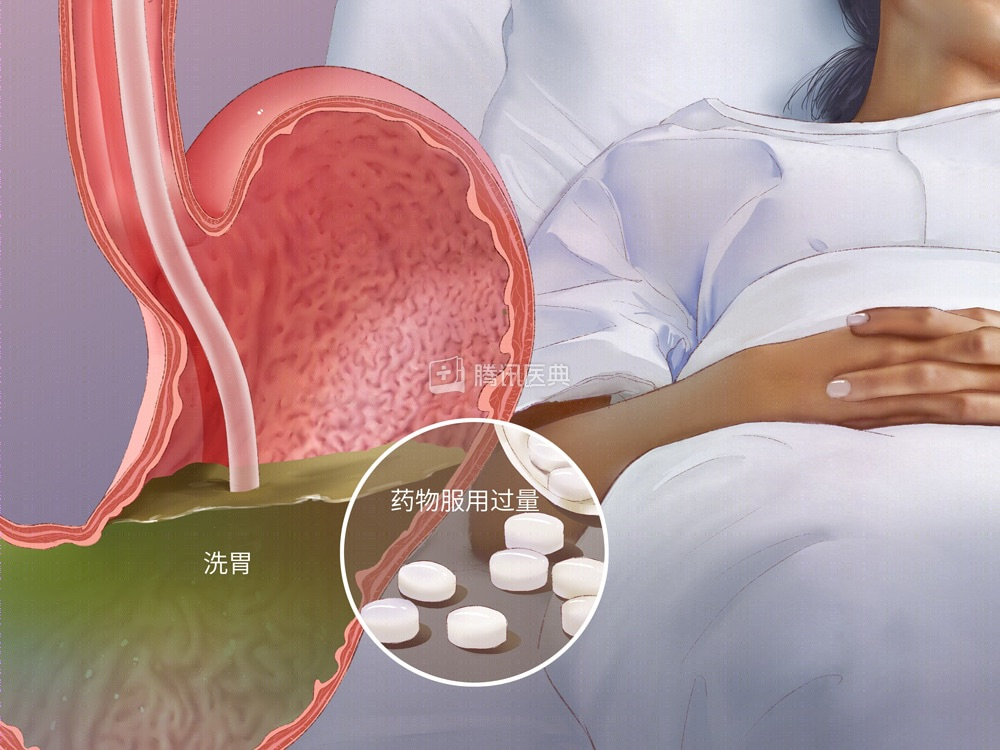 深圳男子误吞150片药，混着白酒！凌晨被姐姐发现瘫在床上！医生：常规洗胃没用 ... ...