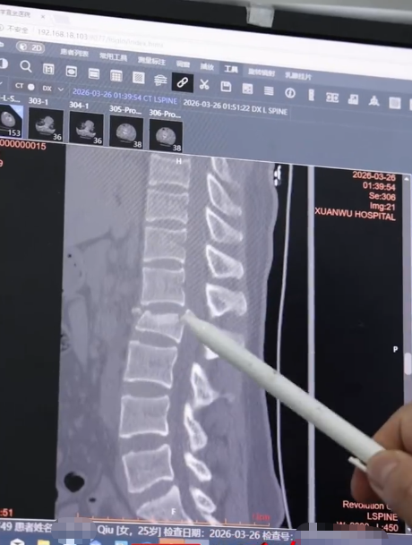 25岁女孩下楼梯时低头玩手机，踩空摔倒致腰椎爆裂性骨折，术前下肢瘫痪大小便失禁 ...