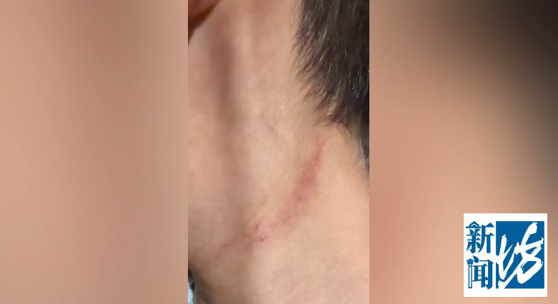 上海一女子称带7岁儿子看病被医生"掐脖掌掴"，验伤报告显示“颈部可见软组  ...