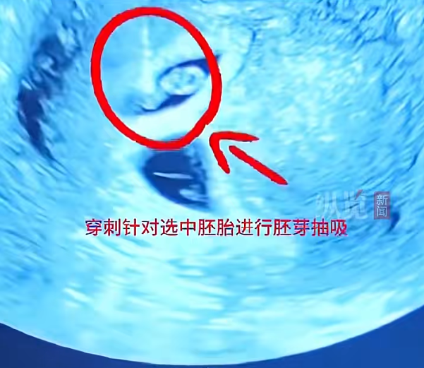 近日，江苏淮安的一名李女士（化名）因备孕困难，自行在药店购买服用“多子丸”（促排卵药物），并且注射促排卵针。用药后其成功怀孕，但早期产检显示竟是四胞胎。李女士一家当时既惊喜又害怕，“高兴的是终于怀上了 ...