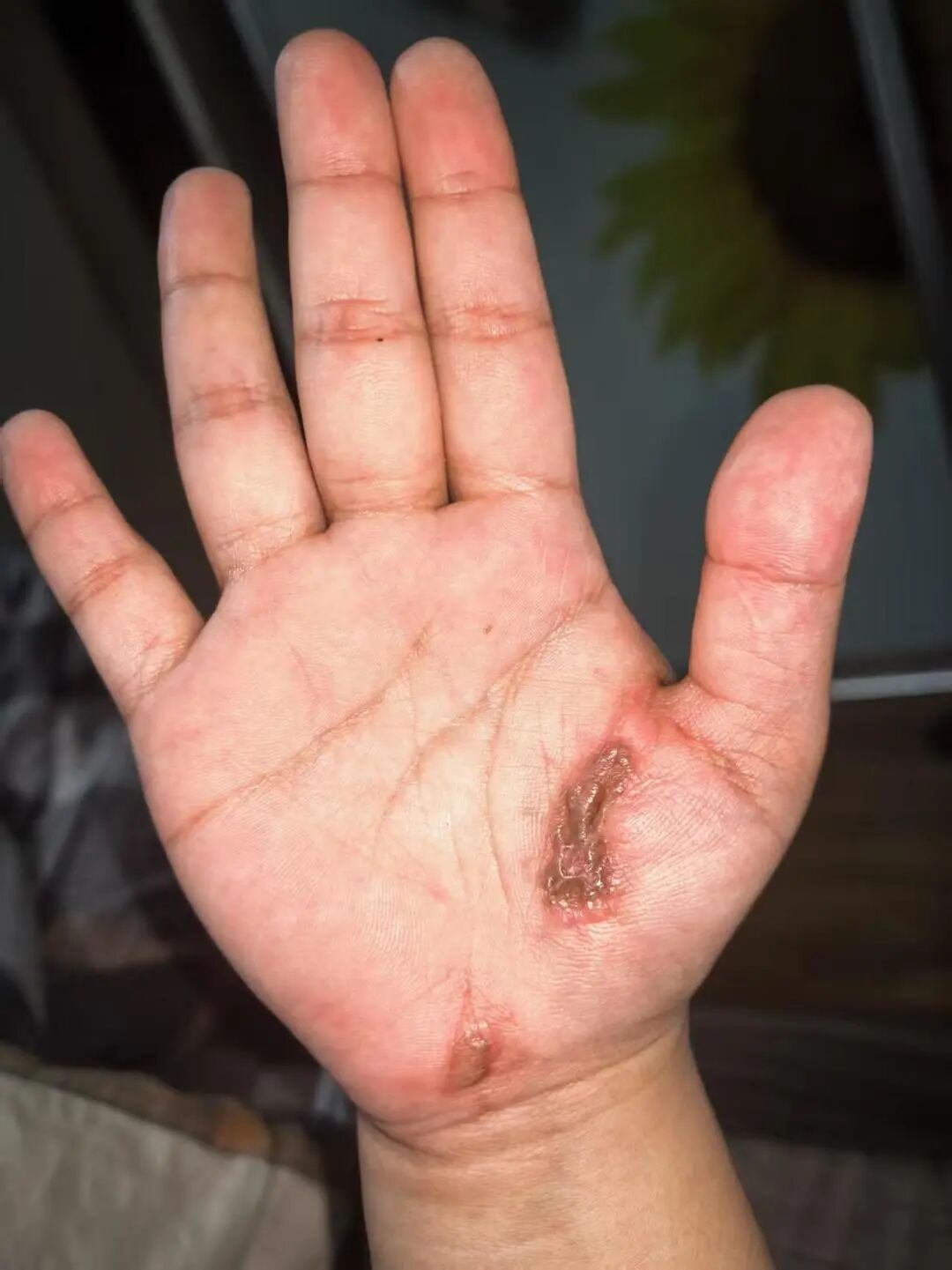 3月5日，贵州遵义的孙女士坐在家中沙发上边充电边玩手机时被电击，幸被表弟及时发现送医救治捡回一命。医生表示这是他第一次遇见这样的病例，此前他也只是在网上看见过。孙女士手掌留下的伤疤4月28日，孙女士接受采  ...